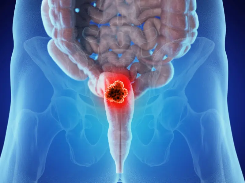 Gallbladder Cancer Image